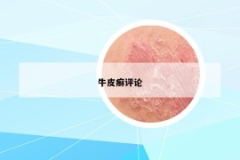 牛皮癬評(píng)論