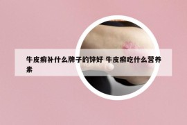 牛皮癬補什么牌子的鋅好 牛皮癬吃什么營養(yǎng)素