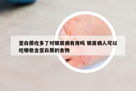 蛋白質(zhì)吃多了對(duì)銀屑病有用嗎 銀屑病人可以吃哪些含蛋白質(zhì)的食物