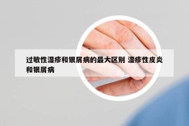 過敏性濕疹和銀屑病的最大區(qū)別 濕疹性皮炎和銀屑病