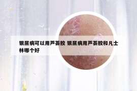 銀屑病可以用蘆薈膠 銀屑病用蘆薈膠和凡士林哪個(gè)好