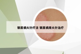 銀屑病火針療法 銀屑病用火針治療