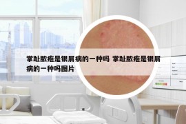 掌趾膿皰是銀屑病的一種嗎 掌趾膿皰是銀屑病的一種嗎圖片