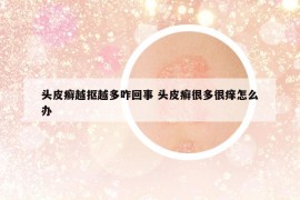 頭皮癬越摳越多咋回事 頭皮癬很多很癢怎么辦