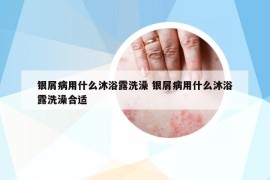 銀屑病用什么沐浴露洗澡 銀屑病用什么沐浴露洗澡合適