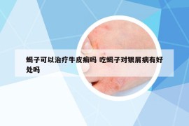 蝎子可以治療牛皮癬嗎 吃蝎子對(duì)銀屑病有好處嗎