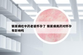 銀屑病吃中藥老婆懷孕了 銀屑病用藥對懷孕有影響嗎