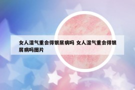 女人濕氣重會得銀屑病嗎 女人濕氣重會得銀屑病嗎圖片
