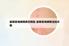 副銀屑病病理典型棘層 副銀屑病病理活檢診斷