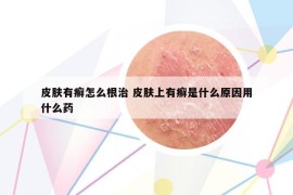 皮膚有癬怎么根治 皮膚上有癬是什么原因用什么藥