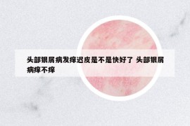 頭部銀屑病發(fā)癢遲皮是不是快好了 頭部銀屑病癢不癢