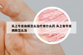 頭上牛皮血癬怎么治療用什么藥 頭上有牛皮病癬怎么治