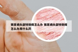 銀屑病頭部特別癢怎么辦 銀屑病頭部特別癢怎么辦用什么藥