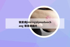 銀屑病jinxingqiyouduochang 銀屑病圖片