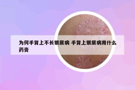 為何手背上不長銀屑病 手背上銀屑病用什么藥膏