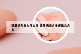 銀屑病東北為什么多 銀屑病南方多還是北方多