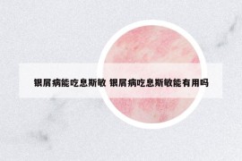 銀屑病能吃息斯敏 銀屑病吃息斯敏能有用嗎