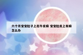 六個(gè)月寶寶肚子上出牛皮癬 寶寶肚皮上有癬怎么辦