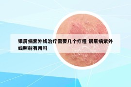 銀屑病紫外線治療需要幾個療程 銀屑病紫外線照射有用嗎