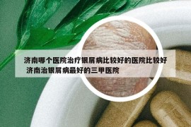 濟(jì)南哪個(gè)醫(yī)院治療銀屑病比較好的醫(yī)院比較好 濟(jì)南治銀屑病最好的三甲醫(yī)院