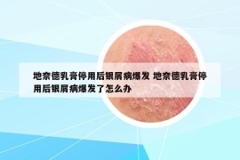 地奈德乳膏停用后銀屑病爆發(fā) 地奈德乳膏停用后銀屑病爆發(fā)了怎么辦