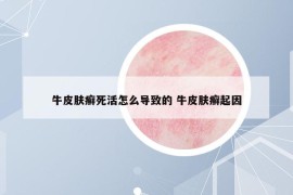 牛皮膚癬死活怎么導致的 牛皮膚癬起因