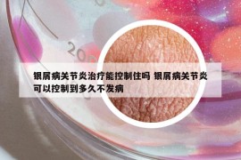 銀屑病關(guān)節(jié)炎治療能控制住嗎 銀屑病關(guān)節(jié)炎可以控制到多久不發(fā)病