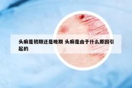 頭癬是初期還是晚期 頭癬是由于什么原因引起的