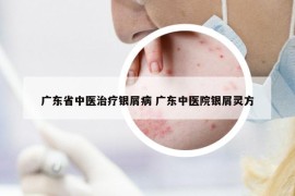 廣東省中醫(yī)治療銀屑病 廣東中醫(yī)院銀屑靈方