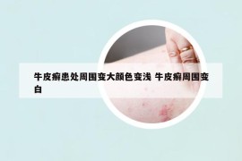 牛皮癬患處周圍變大顏色變淺 牛皮癬周圍變白
