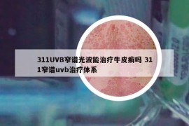 311UVB窄譜光波能治療牛皮癬嗎 311窄譜uvb治療體系
