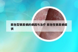 膿包型銀屑病的病因與治療 膿包性銀屑病癥狀