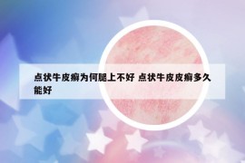 點(diǎn)狀牛皮癬為何腿上不好 點(diǎn)狀牛皮皮癬多久能好