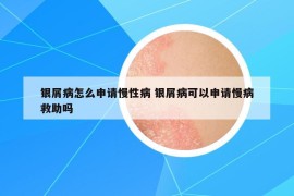 銀屑病怎么申請(qǐng)慢性病 銀屑病可以申請(qǐng)慢病救助嗎