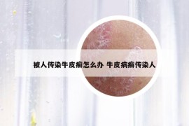 被人傳染牛皮癬怎么辦 牛皮病癬傳染人
