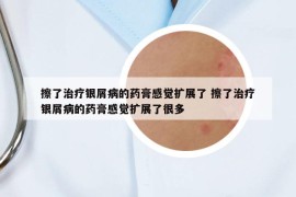 擦了治療銀屑病的藥膏感覺擴(kuò)展了 擦了治療銀屑病的藥膏感覺擴(kuò)展了很多