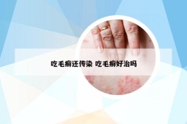 吃毛癬還傳染 吃毛癬好治嗎