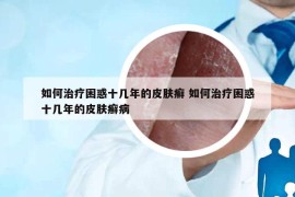 如何治療困惑十幾年的皮膚癬 如何治療困惑十幾年的皮膚癬病