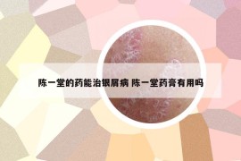 陳一堂的藥能治銀屑病 陳一堂藥膏有用嗎