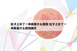 肚子上長了一塊癬是什么原因 肚子上長了一塊癬是什么原因圖片