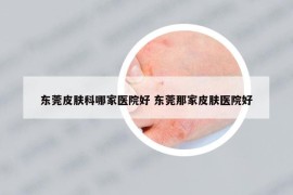 東莞皮膚科哪家醫(yī)院好 東莞那家皮膚醫(yī)院好
