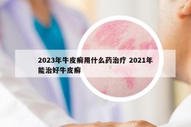 2023年牛皮癬用什么藥治療 2021年能治好牛皮癬