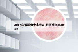 2014年銀屑病專家共識 銀屑病指南2019