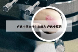 盧氏中醫(yī)治療牛皮癬方 盧氏中草藥