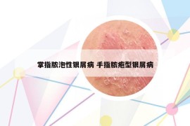 掌指膿泡性銀屑病 手指膿皰型銀屑病