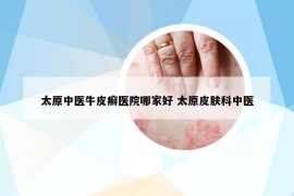 太原中醫(yī)牛皮癬醫(yī)院哪家好 太原皮膚科中醫(yī)