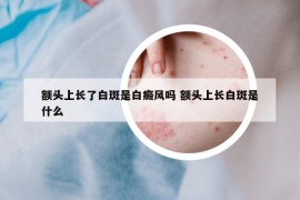 額頭上長了白斑是白癜風嗎 額頭上長白斑是什么