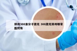 鄭州308準(zhǔn)分子激光 308激光鄭州哪家醫(yī)院有