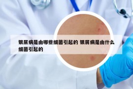 銀屑病是由哪些細(xì)菌引起的 銀屑病是由什么細(xì)菌引起的