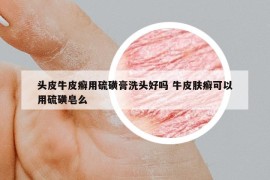 頭皮牛皮癬用硫磺膏洗頭好嗎 牛皮膚癬可以用硫磺皂么